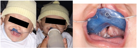 Shutter adapted in the patient's mouth.