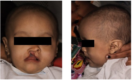 Front Image. Cleft palate (right side), depression of the nasal wing on the same side. Braquifacial biotype. Lateral image presents slight concave profile.