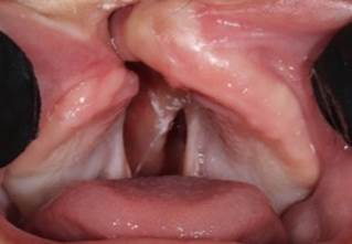 Upper jaw. Complex palatal fissure, hard palate and soft palate, with unilateral cleft lip. Compressed right jaw