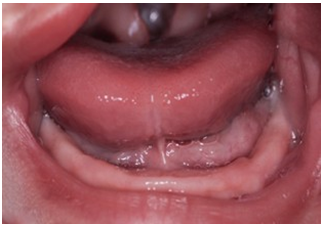 Lower jaw, without eruption of temporary pieces