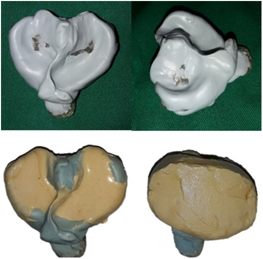 Prints out of mouth and emptied in stone plaster to obtain models.