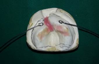 Delimitation of the prosthetic area and relief zone formation, plus double 0.036 orthodontic wire to adapt the Shutter.