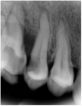 Hard tissue defect at 15 & 16.