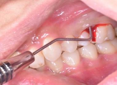 Pocket depth of more than 15mm.