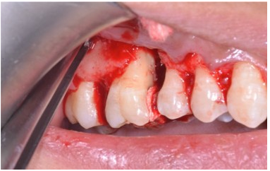 Bony defect exposed.