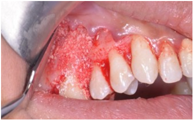 Bone allograft powder condensed.