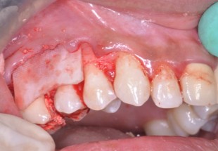 Membrane placed over the graft.