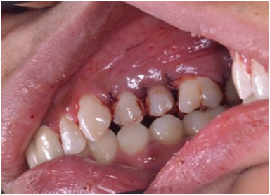 Interrupted silk suture placed.