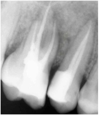 Hard tissue healing after 3 months.