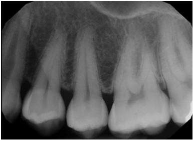 Periapical X ray of the pain area.
