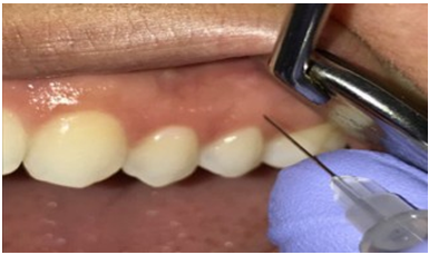Intraoral sites of infiltration- interpapillary 24/25 and attached gingiva.