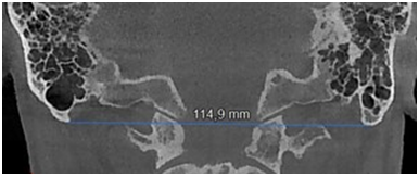 Bimastoid diameter measurement on the coronal CBCT scan.