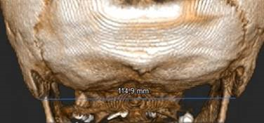 Bimastoid diameter measurement on 3D reconstruction.