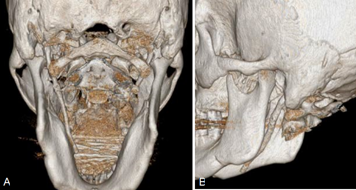Estudio de tomograf&iacute;a computarizada. A. Estudio tomogr&aacute;fico con reconstrucci&oacute;n en 3D, vista posterior, observ&aacute;ndose la elongaci&oacute;n del proceso estiloideo de lado izquierdo. B. Estudio tomogr&aacute;fico con reconstrucci&oacute;n en 3D, vista lateral de lado izquierdo, observ&aacute;ndose la elongaci&oacute;n y su extensi&oacute;n del proceso estiloideo.