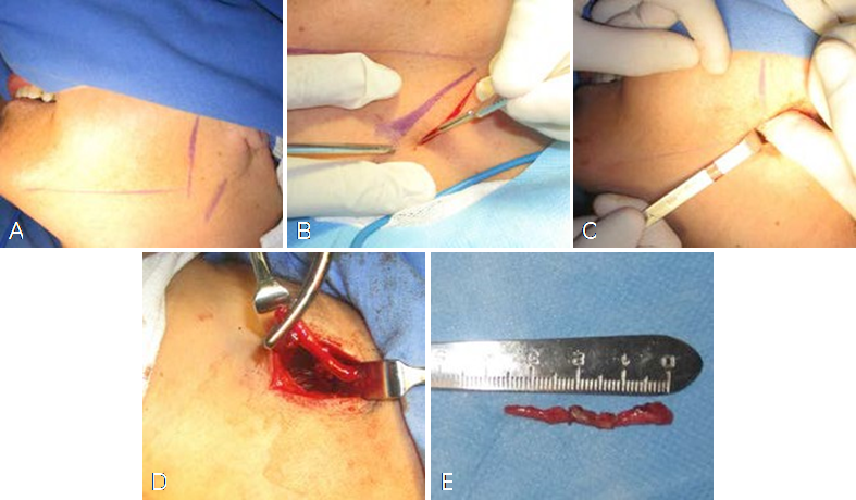 Fotograf&iacute;as intraoperatorias. A. Marcaje quir&uacute;rgico del borde posterior e inferior mandibular y borde anterior del m&uacute;sculo esternocleidomastoideo. B. Incisi&oacute;n realizada en piel y tejido celular subcut&aacute;neo con hoja de bistur&iacute; #15. C. Disecci&oacute;n roma digital para localizacion del &aacute;pice del proceso estiloideo. D. Fractura y extracci&oacute;n con pinzas Rochester del proceso estiloideo. E. Esp&eacute;cimen y medici&oacute;n del proceso estiloideo de alrededor de 3.5 cm de longitud.