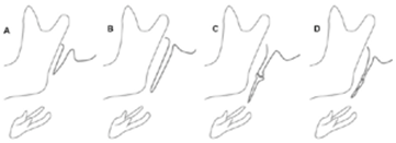 Representaci&oacute;n esquem&aacute;tica de patrones de calcificaci&oacute;n o mineralizaci&oacute;n del proceso estiloideo de Langlais. A. Normal; B. Elongado; C. Pseudoarticulado; D. Segmentado.