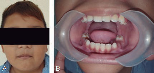 First clinical examination. (A) Facial view on the first visit, (B) Normal clinical appearance of intraoral tissues.