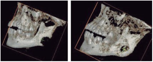 Tomography with 3D reconstruction left lateral view. (A) A well-defined hypodense image measuring 2.3 x 2.4 cm is observed in the left mandibular angle, compatible with an osteolytic lesion (pre operative). (B) Bone regeneration is observed at the edge of the left mandibular angle secondary to chemotherapy, 8 months after diagnosis.