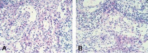 (A) Histopathology examination demonstrate a diffuse infiltration of mononuclear cells that resemble histiocytes, these cells have indistinct cytoplasmic borders and rounded or dentate vesicular nuclei, typically a variable number of eosinophils are interspersed between the cells with a histiocytic appearance histiocytes (haematoxylin-eosin). (B) Plasma cells and lymphocytes are observed along with areas of hemorrhage, all supported by a stroma of collagen fibers (haematoxylin-eosin).