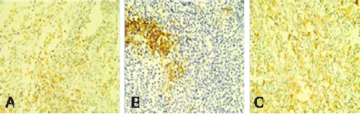 Immunohistochemical staining showing reactivity for (a) S-100, (b) CD1a, (c) CD68 positivity (x20).