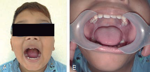 Clinical examination post-biopsy and chemotherapy. (a) Facial view with good appearance, (b) Normal clinical appearance of intraoral tissues.