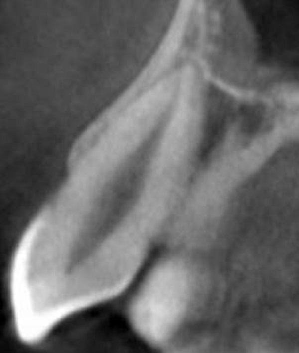 CBCT cross sectional image of maxillary canine teeth Type I.