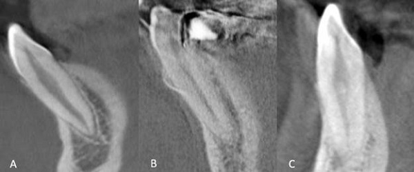 CBCT cross sectional images of mandibular canine teeth (A) Type I, (B) Type II, (C) Type III.
