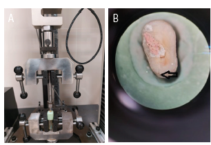 A. Universal testing machine usedto induce VRF in roots. B. Arrow: VRF in the lingual aspect of the root.