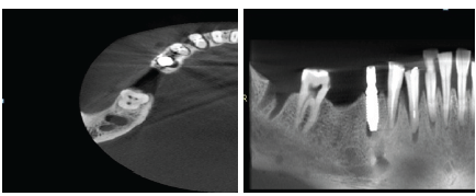 CBCT images for evaluation of VRF in right canine and right first premolar. A. Axial view. B. Panoramicreformat.