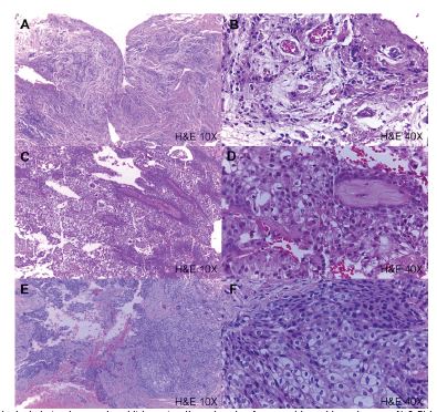 Histopathological photomicrographs whit hematoxylin and eosin of mucoepidermoid carcinomas. A) & B) low-grade mucoepider- moid carcinoma; C) & D) intermediate-grade mucoepidermoid carcinoma, and E) & F) high-grade or clear cell mucoepidermoid carcinoma. A), C), & E) 10 X magnification and B), D) & F) 40X magnification.