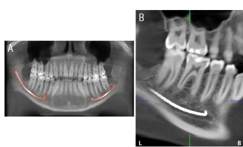 Location of the mandibular canal in CBCT. (A) Panoramic thin-section image showing the mandibular canal (B) Oblique sagital section showing the path of the mandibular dental canal on the right side and its relationship to the apex of the mesial roots of the first and second molars; as well as the second premolar.