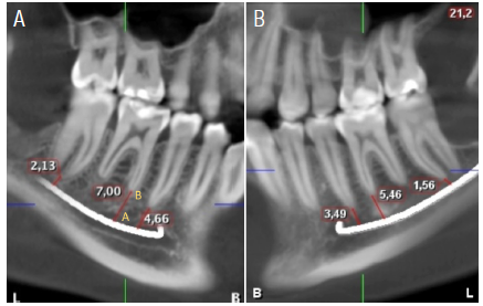 Vertical linear measurements of the distances from the mandibular nerve to the apex of the roots of the posterior teeth on CBCT. (A) Oblique sagittal section showing the vertical measurements from the upper edge of the mandibular canal (POINT A) to the apex of the mesial roots of the first and second molars (POINT B); as well as the distance from the roots of the second premolar on the right side, (B) measurements made in the left hemiarch.