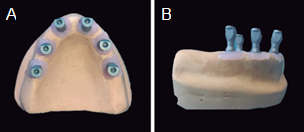 Images of the master model (A; occlusal view, B; lateral view).