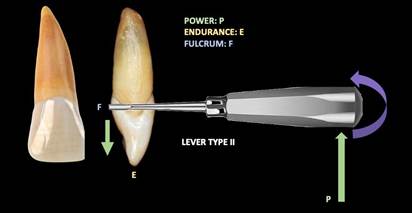 It is observed how the power (P) in green, the rest (F) in blue, are applied on the straight elevator and the resistance (E) is found between these two, P and F, this is the fundamental two armed-lever.