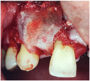 Bone graft puros cortico-cancellous and membran.