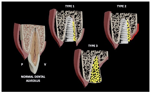 According to the type of socket left post-extraction and after applying the two armed-lever, it is showing here the alternatives for handling the three types of post- extraction sockets explained.