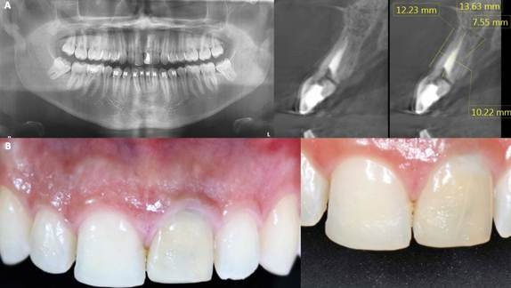 A. Initial panoramic radiography and cone beam. B. Clinical view of the upper left central incisor.