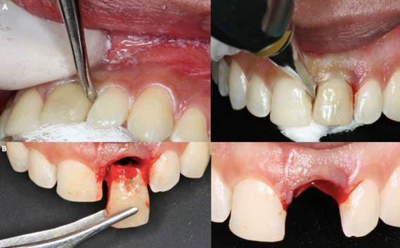 A. Two-armed lever. B. Crown Extraction.