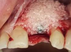 Graft and implant placed.