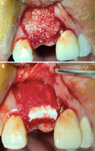 A. Implant placed. B. Bone graft and collagen membrane.