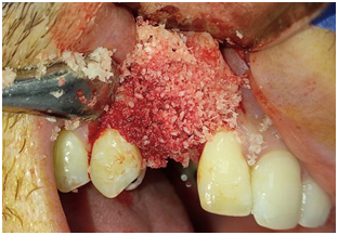 Bone graft puros cortico-cancellous.