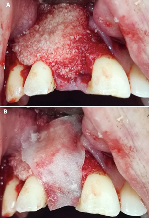 A. Implant and bone graft puros cancellous. B. Collagen membrane.