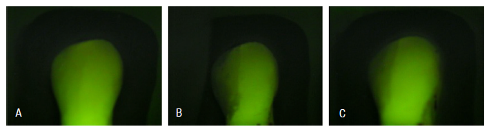 A. A healthy tooth, displaying the baseline mineral content and fluorescence; B. A tooth after the demineralization process, showing a reduction in mineral content and fluorescence intensity, evidenced by the appearance of a white spot; C. (GI) A tooth after prophylaxis with a Robinson brush and pumice stone, indicating the effect of the treatment on the tooth's mineral content.