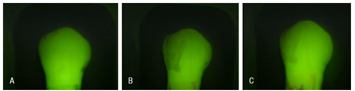A. A healthy tooth, displaying the baseline mineral content and fluorescence; B. A tooth after the demineralization process, showing a reduction in mineral content and fluorescence intensity, evidenced by the appearance of a white spot; C. (GII) Tooth after prophylaxis with Robinson brush and prophylactic paste, indicating the effect of treatment on the mineral content of the tooth.