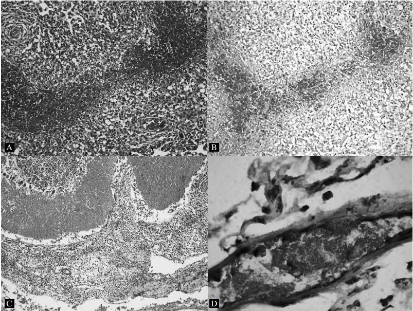Histology sections from aborted bovine fetuses infected with Brucella
abortus. A. Lung, acute multifocal necrosuppurative bronchopneumonia (100x
magnification, HE). B. Lung, red immunohistochemical staining of B. abortus
bacterial antigens in necrotic foci (100x magnification). C. Cerebelum, focally
extensive granulomatous meningitis (100x magnification). D. Placenta, red
immunohistochemical staining of B. abortus bacterial antigens in blood vessel
(400x magnification, HE).