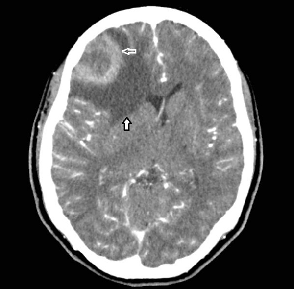 TC con contraste. Lesión ocupante de espacio con efecto masa ubicada en la región frontotemporal derecha. Se aprecia la lesión con centro hipodenso y bordes con realce en forma anular (flecha blanca). Así mismo se observa una zona hipodensa alrededor de la lesión correspondiente a edema vasogénico (flecha negra); se tiene como diagnósticos diferenciales tumor primario en SNC (Glioblastoma multiforme) o metástasis.