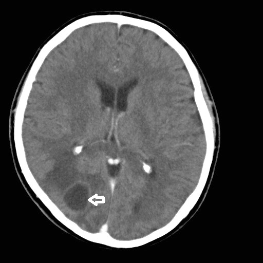 TC simple. En la imagen se aprecia una lesión en la región occipital derecha, con centro hipodenso bien delimitada dentro de una cápsula hiperdensa (flecha blanca), la cual corresponde a un absceso cerebral en etapa capsular tardía.