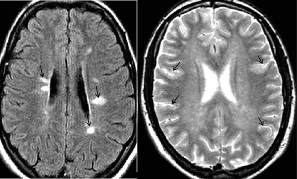 a la derecha RM corte T1 que muestra lesiones intraparenquimatosas periventriculares hiperintensas. se aprecia patrón en sierra en lesiones cercanas el ventrículo lateral derecho (flechas negras). A la Izquierda se evidencia Lesiones yuxtacorticales en secuencia FLAIR (flechas negras)