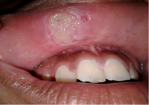 Úlcera en mucosa labial superior