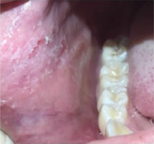 Múltiples lesiones traumáticas asociadas al hábito de mordisqueo